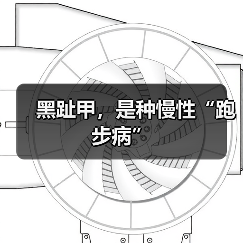 黑趾甲，是种慢性“跑步病”（图2）