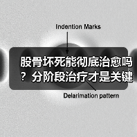 股骨坏死能彻底治愈吗?分阶段治疗才是关键(图2) 股骨坏死能彻底治愈吗?分阶段治疗才是关键(图2)