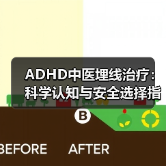 ADHD中医埋线治疗:科学认知与安全选择指南(图4) ADHD中医埋线治疗:科学认知与安全选择指南(图4)