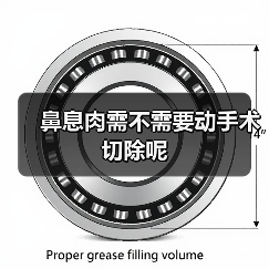 鼻息肉需不需要动手术切除呢(图3) 鼻息肉需不需要动手术切除呢(图3)